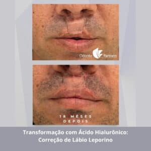Antes e depois de 18 meses da correção de cicatriz de lábio leporino com preenchimento de ácido hialurônico, realizado na Odonto Partners.