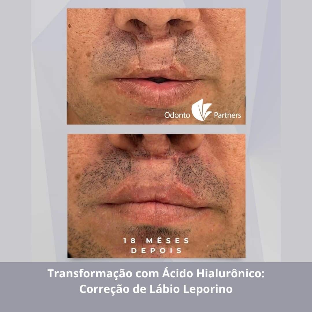 Antes e depois de 18 meses da correção de cicatriz de lábio leporino com preenchimento de ácido hialurônico, realizado na Odonto Partners.