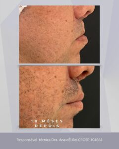 Detalhe do ganho de volume e melhora na textura do lábio superior após aplicação de ácido hialurônico, técnica avançada em estética orofacial.