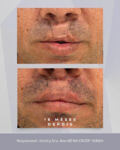 Vista lateral do antes e depois do preenchimento labial com ácido hialurônico para simetria facial e camuflagem de cicatriz.