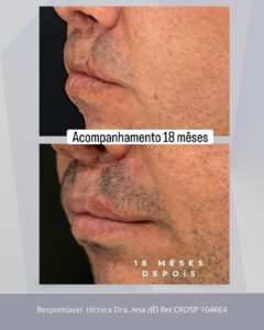 Antes e depois de 18 meses da correção de cicatriz de lábio leporino com preenchimento de ácido hialurônico, caso clínico da Dra. Ana Carla na Odonto Partners.